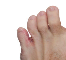 foot with athlete's foot on pinky toe
